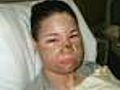 2 Acid Attacks Happen In Different States