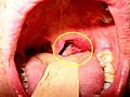 Sex Infection Leading To Oral Cancer