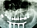 Diş implantı hangi durumlarda kullanılır?