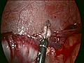 Laparoscopic Appendectomy HD