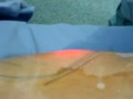 laser liposuction qatar