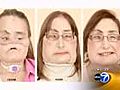 Woman undergoes first face transplant in U.S.