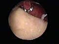 Litholapaxy (Crushing of a Bladder Stone)