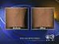 Health: New Spider Vein Treatment