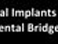 Cosmetic Dentist Harrisonburg VA Dental Implants Dental Bridge