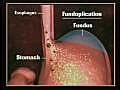 腹腔鏡手術の応用で治療効果を高める／重度の胸焼けに対する新外科療法