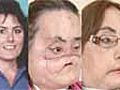 Face transplant woman Connie Culp speaks