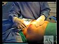 gynecomastia surgery