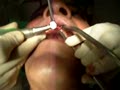 Oral Surgery - Preparation For Implant Part 2