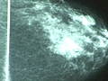 Breakthrough in Breast Cancer Treatment?