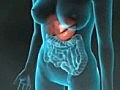 3D Medical Animation: Gallbladder Removal Surgery