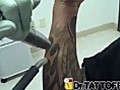 Tattoo Removal - Half Sleeve Tribal Flames