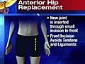 Anterior hip replacement surgery